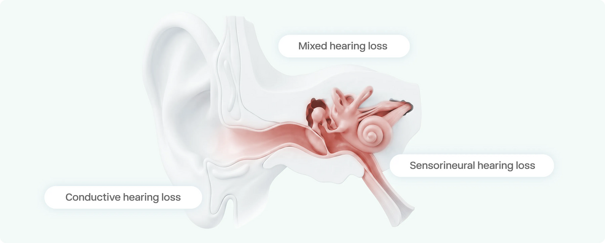 Types of hearing loss